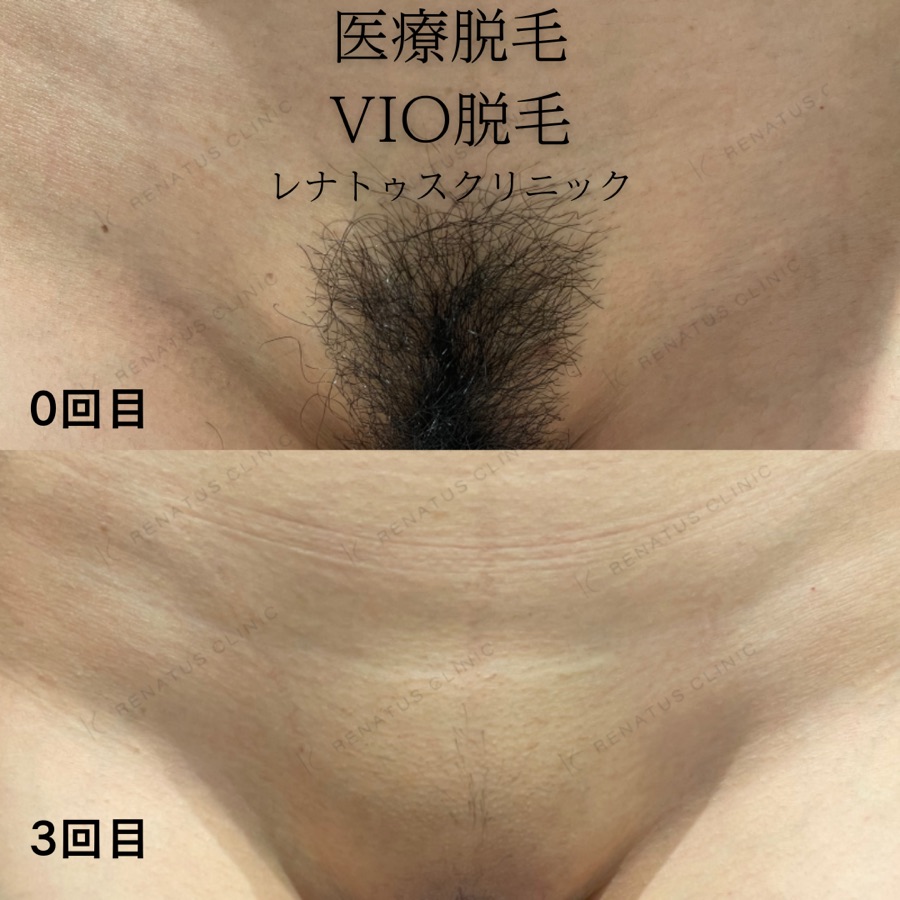 VIO脱毛 施術症例写真