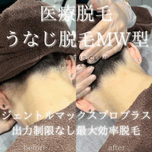 医療脱毛 うなじ脱毛MW型