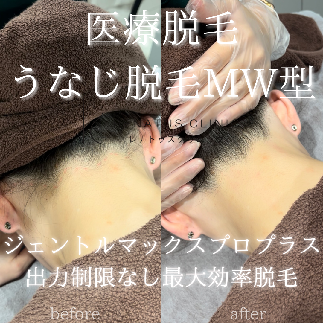 うなじ・生え際の脱毛イメージ