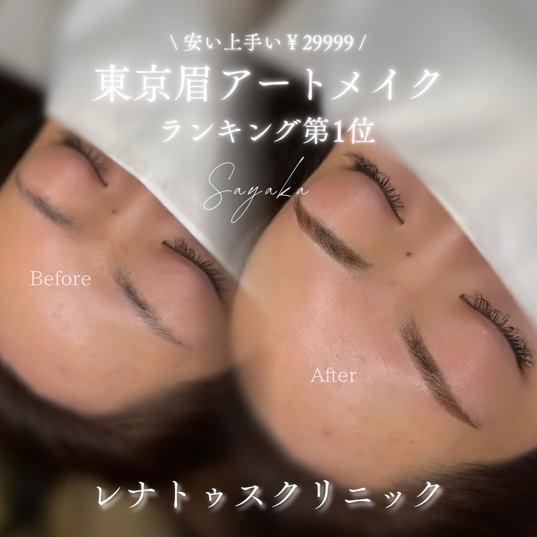 名古屋の眉毛アートメイク 安い上手いレナトゥスクリニック